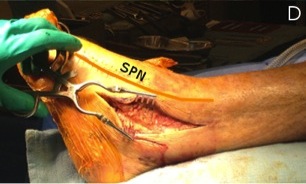 Anterolateral Approach Ankle